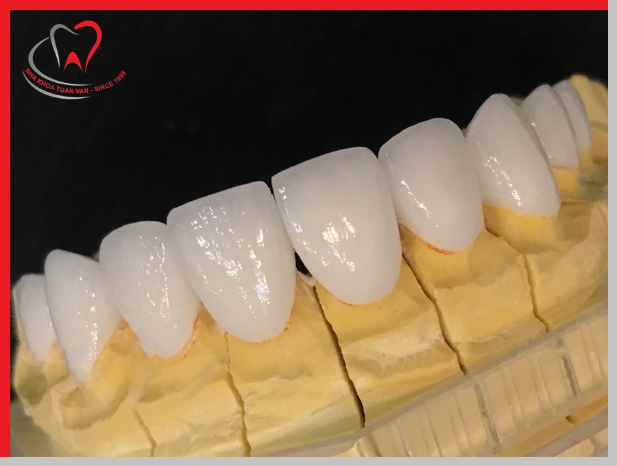 Răng sứ không kim loại Lava Esthetic