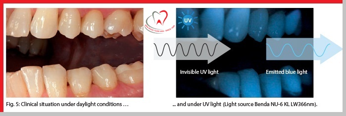Răng sứ không kim loại Lava Esthetic
