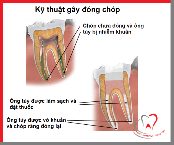 ky-thuat-dong-chop