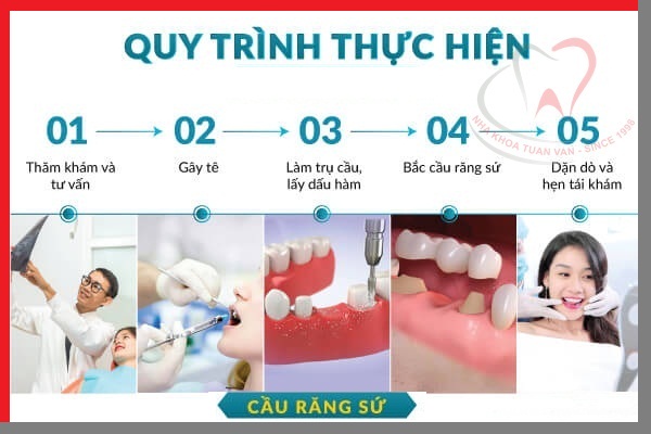 quy-trinh-lam-cau-rang-su