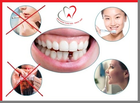 luu-y-sau-khi-cay-ghep-implant