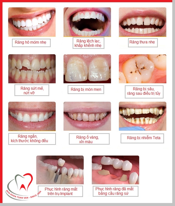 Răng sứ không kim loại Lava Esthetic