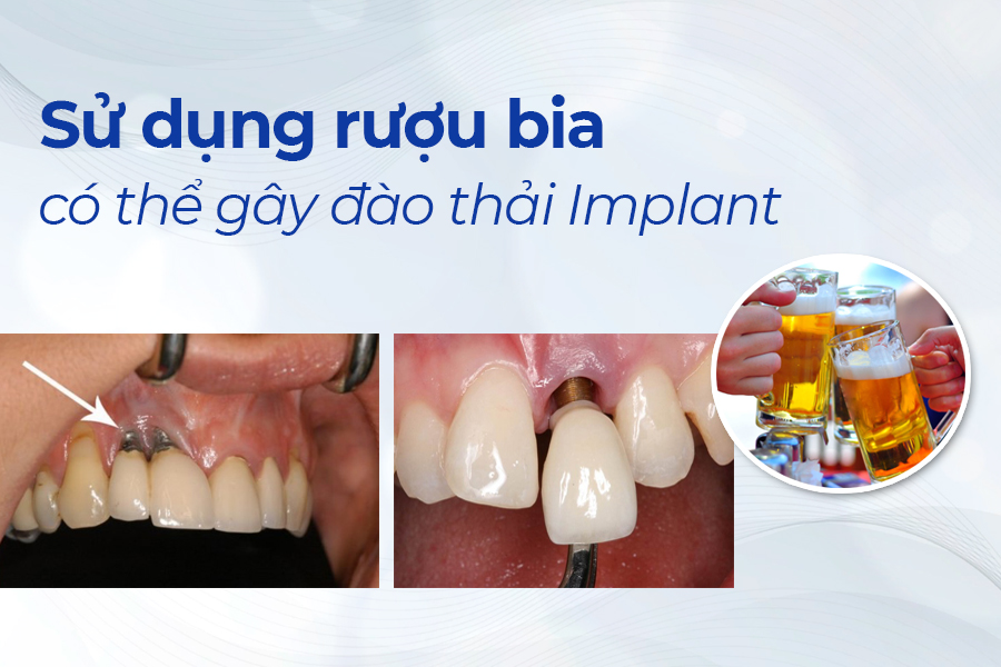 UỐNG RƯỢU, BIA CÓ THỂ GÂY ĐÀO THẢI RĂNG IMPLANT?