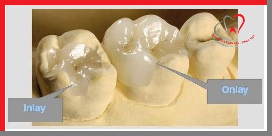 han-rang-inlay-onlay