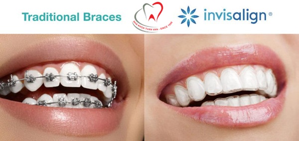 Niềng răng trong suốt Invisalign