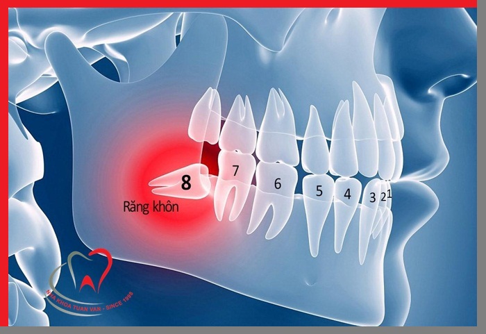 nho-rang-khon-moc-lech