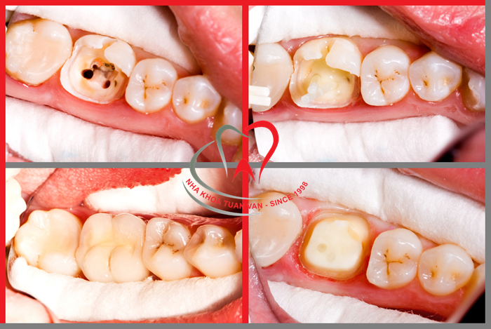 phuc-hinh-rang-su-sau-dieu-tri-tuy