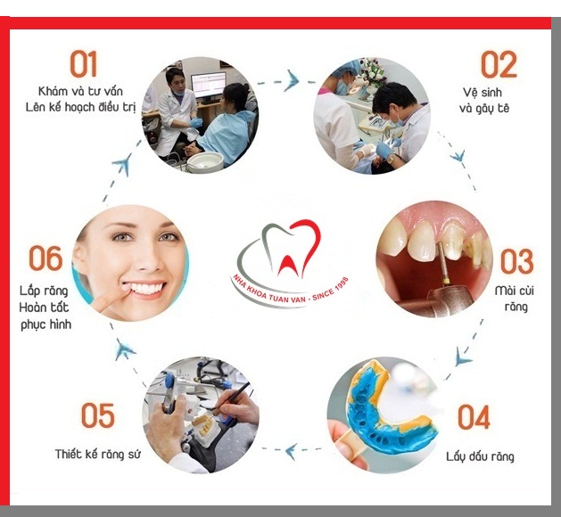 quy-trinh-boc-rang-su