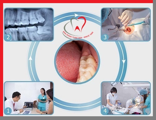 quy-trinh-nho-rang-khon