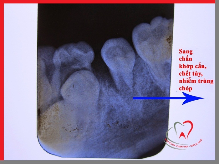 nhiem-trung-cuong-rang