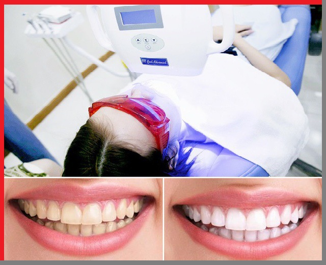 tay-trang-rang-duoc-bao-lau