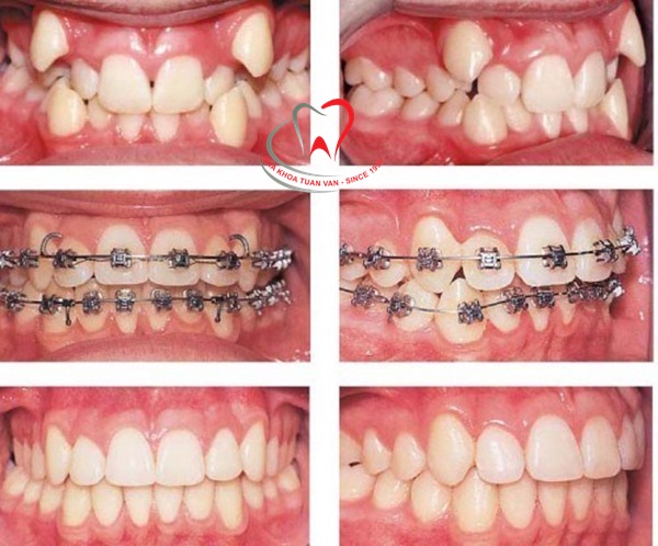 ket-qua-sau-nieng-rang