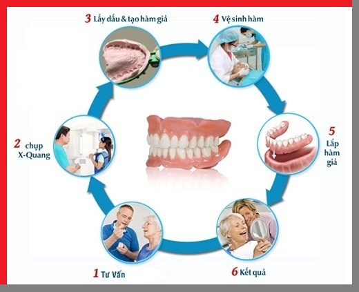 quy-trinh-trong-rang