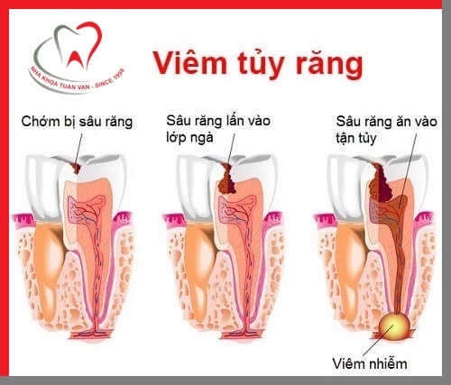 cac-giai-doan-viem-tuy-rang
