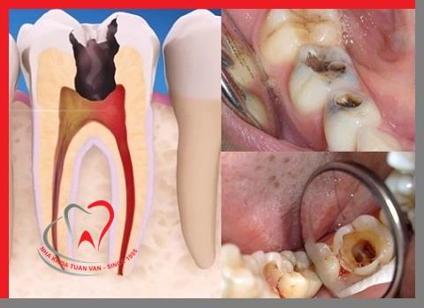 ĐIỀU TRỊ TỦY RĂNG