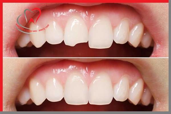 HÀN RĂNG (TRÁM RĂNG)