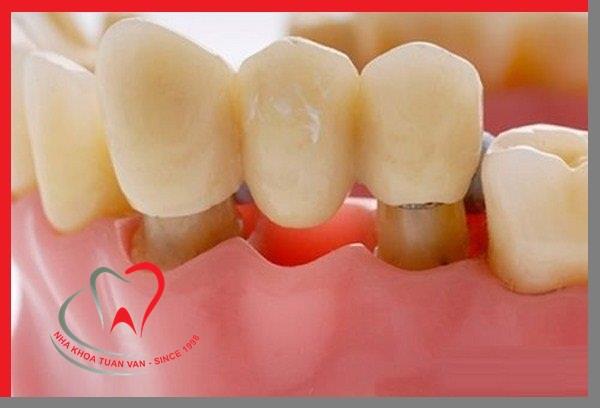 RĂNG GIẢ CỐ ĐỊNH