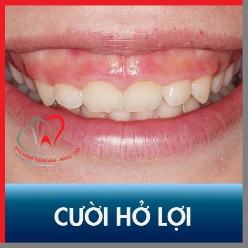 Cười hở lợi: Nguyên nhân và cách khắc phục?