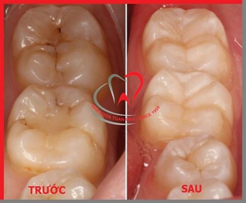Trám bít hố rãnh dự phòng sâu răng