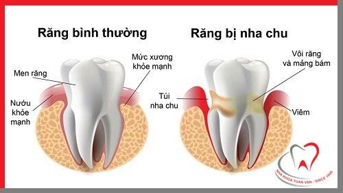 Bệnh viêm nha chu có lây không?