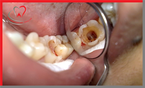 Triệu chứng sau khi lấy tủy răng: Bình thường và bất thường