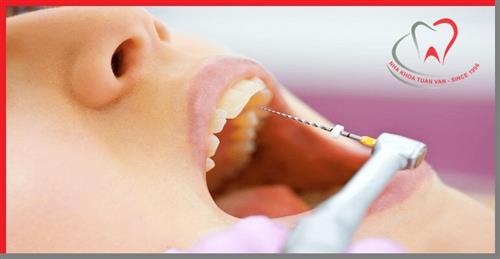 Chăm sóc răng sau điều trị tủy