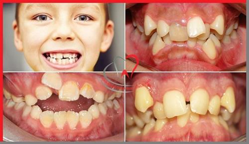 Tại sao răng bị mọc lệch?