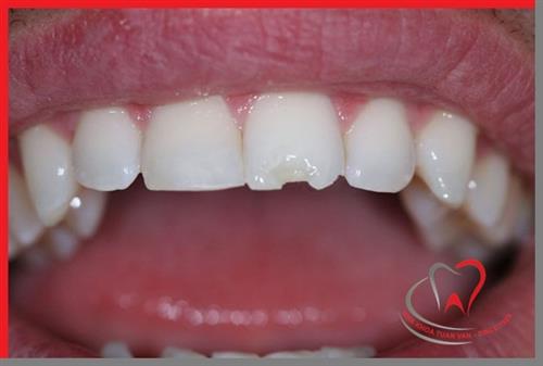 Răng sứ bị mẻ có trám lại được không?