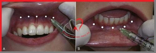 Thuốc tê có tác dụng bao lâu khi nhổ răng?