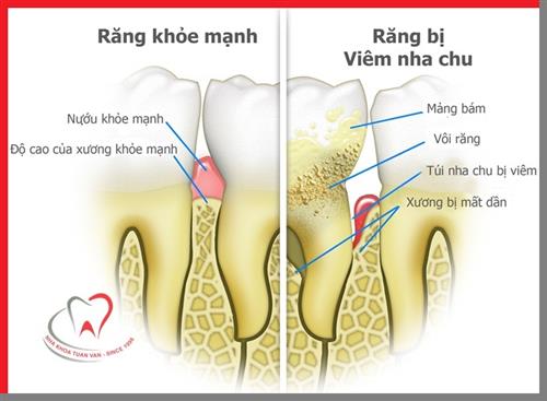 Điều trị viêm nha chu