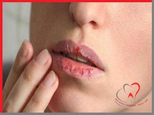 Khô miệng - Tác nhân gây sâu răng