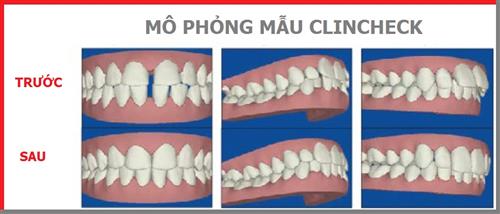 Clincheck trong chỉnh nha là gì?