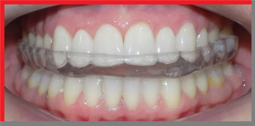 Tại sao máng nhai có thể điều trị bệnh lý viêm khớp thái dương hàm?