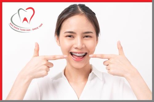 Nhược điểm khi niềng răng ở người lớn?