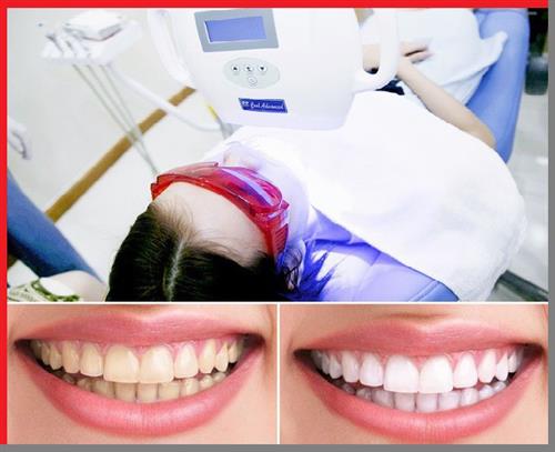 Tẩy trắng răng duy trì được bao lâu?