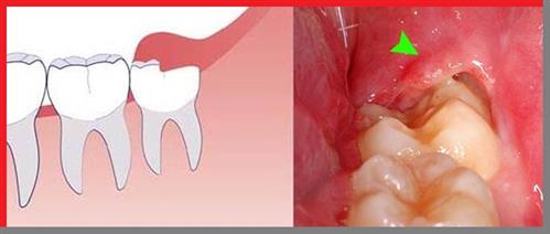 Phương pháp điều trị dứt điểm viêm lợi trùm