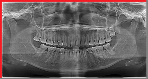 Tại sao phải chụp X Quang trước khi niềng răng?