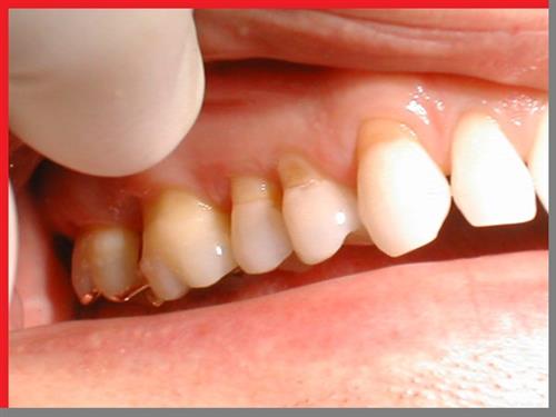 Mòn răng: Nguyên nhân, cách điều trị và phòng ngừa