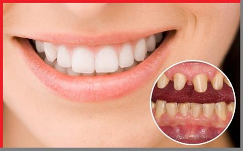 Có nên mài răng làm răng sứ?