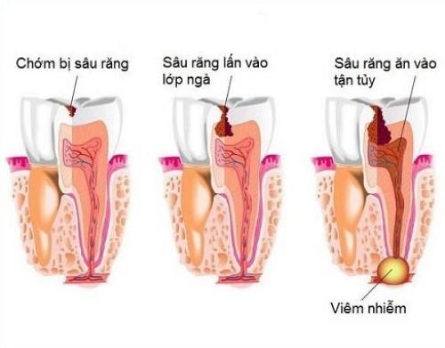 Răng Hàm Bị Sâu Có Nên Nhổ Không?