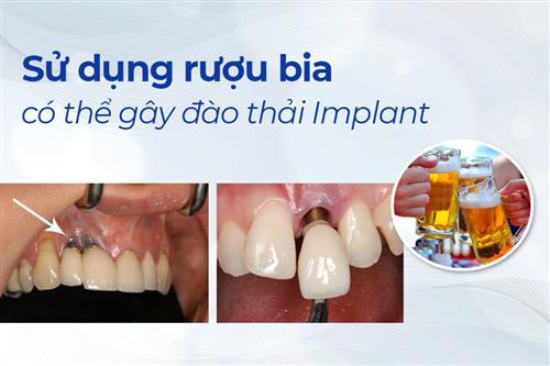 UỐNG RƯỢU, BIA CÓ THỂ GÂY ĐÀO THẢI RĂNG IMPLANT?