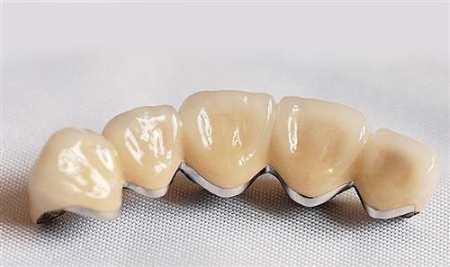 Trồng răng răng sứ Titan - Cho hàm răng sáng và nụ cười tươi!